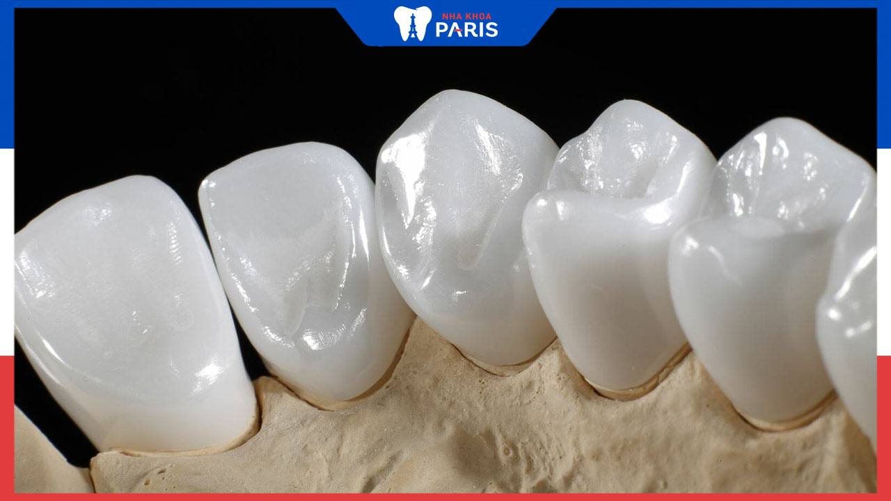 Bọc răng toàn sứ giá bao nhiêu tại nha khoa Paris